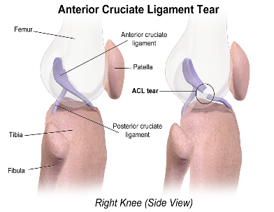 All about the ACL: What is it and how do I prevent an injury? (Part 1)